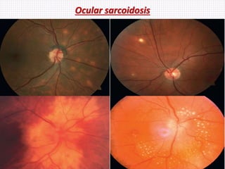 Ocular sarcoidosis
 