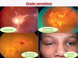 Ocular sarcoidosis
Periphlebitis
Disc odema,
periphlebitis
Periphlebitis,
OD granuloma
Lacrimal
gland ++
 