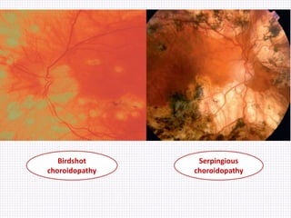 Birdshot
choroidopathy
Serpingious
choroidopathy
 