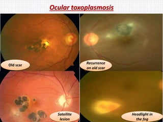 Ocular toxoplasmosis
Old scar Recurrence
on old scar
Satellite
lesion
Headlight in
the fog
 