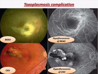 Toxoplasmosis complication
BRAO
Hypoflurescence
of BRAO
CNV
Hyperflurescence
of CNV
 