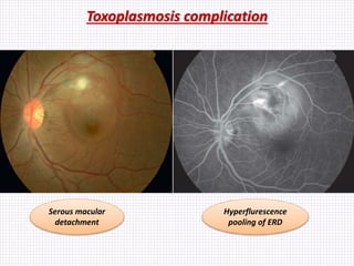 Toxoplasmosis complication
Serous macular
detachment
Hyperflurescence
pooling of ERD
 