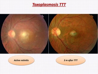 Toxoplasmosis TTT
Active retinitis 3 m after TTT
 