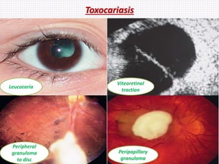 Toxocariasis
Leucocoria
Peripheral
granuloma
to disc
Viteoretinal
traction
Peripapillary
granuloma
 
