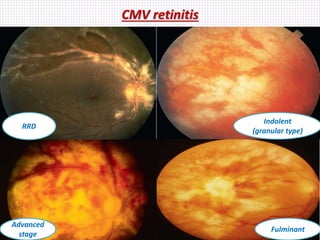 CMV retinitis
Indolent
(granular type)
Fulminant
Advanced
stage
RRD
 
