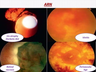 ARN
Iris atrophy
(herbetic AU)
Vitritis
Retinal
necrosis
Perivascular
hge
 