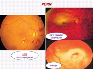 PORN
Early macular
involvment
No hge,
HIV
microangiopathy
 