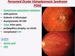 Persumed Ocular Histoplasmosis Syndrome
POHS
• Histoplasma capsulatum inhalation
• AIDS patients
• Endemic in Mississippi
• Asymptomatic till CNS
• Triad: histo spots,
• peripapillary atrophy, no vitritis
• Complicated CNV
TTT:
• Amsler grid
• CNV
 