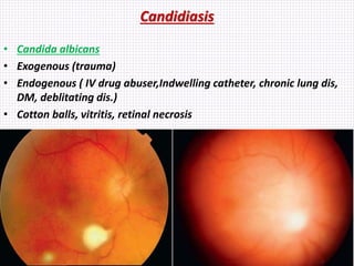 Candidiasis
• Candida albicans
• Exogenous (trauma)
• Endogenous ( IV drug abuser,Indwelling catheter, chronic lung dis,
DM, deblitating dis.)
• Cotton balls, vitritis, retinal necrosis
 