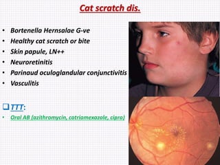 Cat scratch dis.
• Bortenella Hernsalae G-ve
• Healthy cat scratch or bite
• Skin papule, LN++
• Neuroretinitis
• Parinaud oculoglandular conjunctivitis
• Vasculitis
TTT:
• Oral AB (azithromycin, cotriamexazole, cipro)
 
