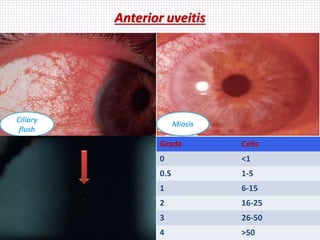 Anterior uveitis
Ciliary
flush
Miosis
Grade Cells
0 <1
0.5 1-5
1 6-15
2 16-25
3 26-50
4 >50
 