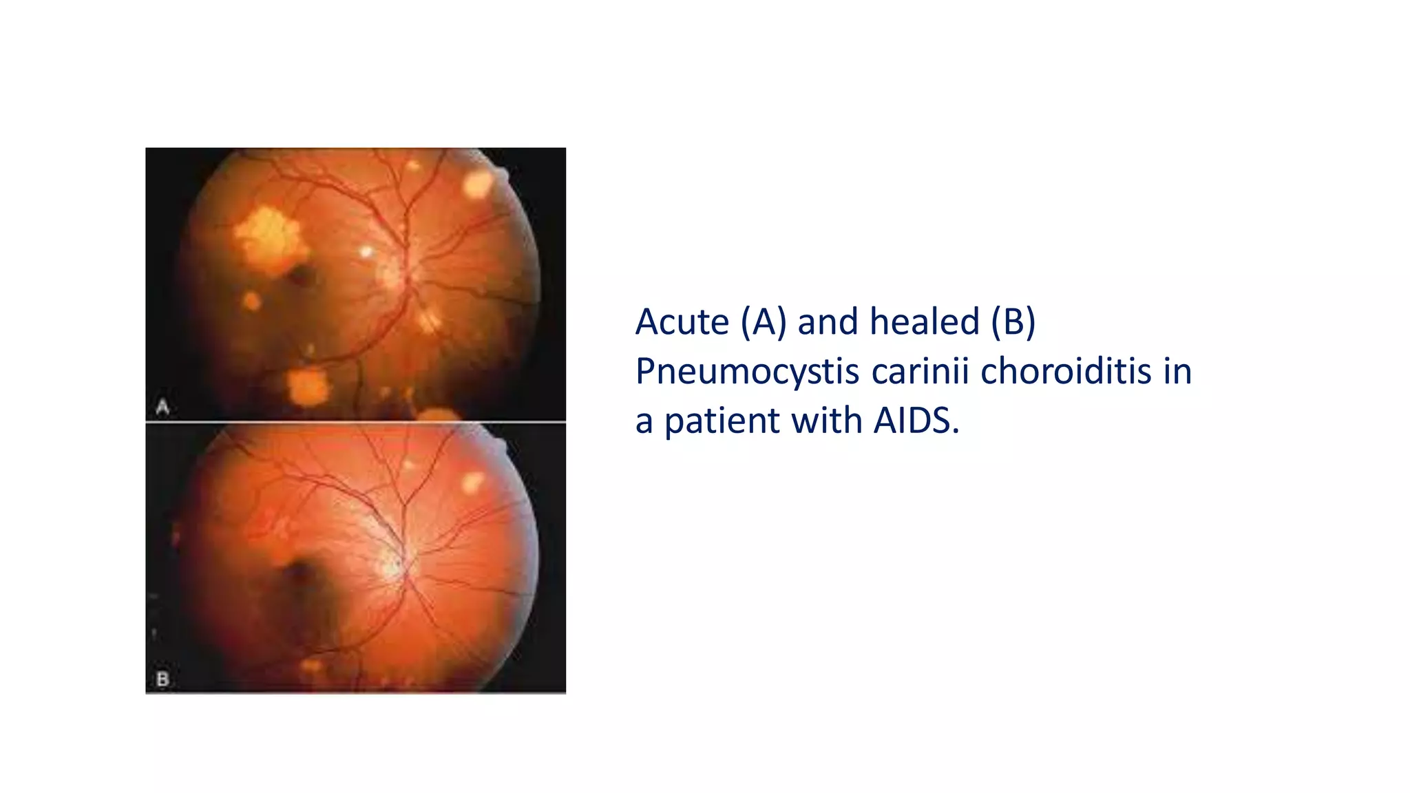 Acute (A) and healed (B)
Pneumocystis carinii choroiditis in
a patient with AIDS.
 