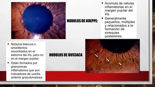 UVEITIS | PPTX