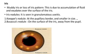 Uveitis. it is an important presentation for uveitis. | PPTX