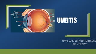 UVEITIS
OPTO LUCY JOHNSON MOONJELY
Bsc Optometry
 