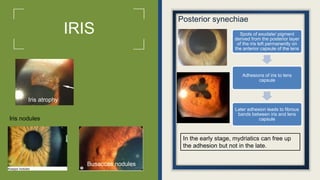 Uveitis its clinical features and management.pptx