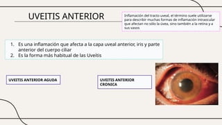 UVEITIS ANTERIOR
1. Es una inflamación que afecta a la capa uveal anterior, iris y parte
anterior del cuerpo ciliar
2. Es la forma más habitual de las Uveítis
UVEITIS ANTERIOR AGUDA UVEITIS ANTERIOR
CRONICA
Inflamación del tracto uveal, el término suele utilizarse
para describir muchas formas de inflamación intraocular
que afectan no sólo la úvea, sino también a la retina y a
sus vasos
 