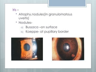 Comprehensive Overview of Uvea Anatomy and Uveitis Management | PPTX