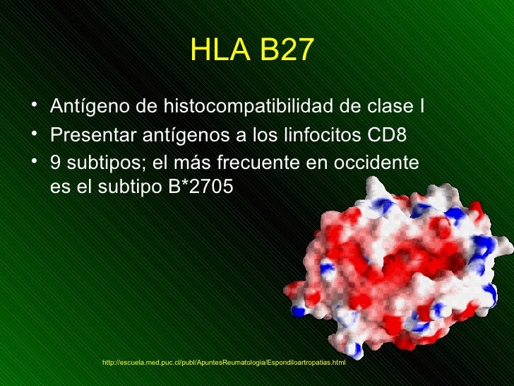 Uveitis Hla B27