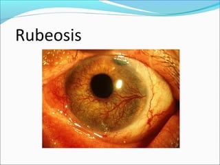 Negative Rubeosis Uveitis | PPT