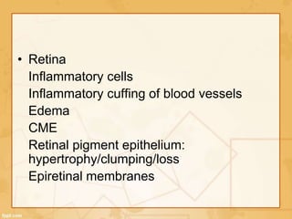 • Retina
Inflammatory cells
Inflammatory cuffing of blood vessels
Edema
CME
Retinal pigment epithelium:
hypertrophy/clumping/loss
Epiretinal membranes
 