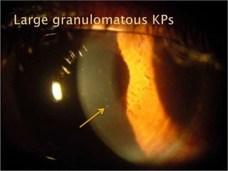 Common Causes of Uveitis Part1