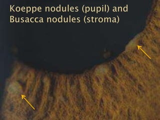 Common Causes of Uveitis Part1