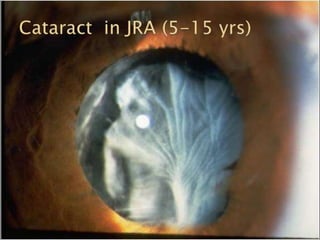 Common Causes of Uveitis Part1