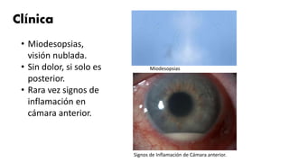 Clínica
• Miodesopsias,
visión nublada.
• Sin dolor, si solo es
posterior.
• Rara vez signos de
inflamación en
cámara anterior.
Miodesopsias
Signos de Inflamación de Cámara anterior.
 