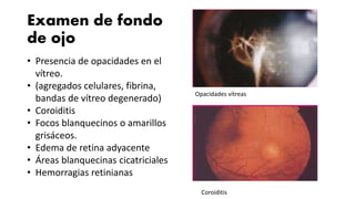 Examen de fondo
de ojo
• Presencia de opacidades en el
vítreo.
• (agregados celulares, fibrina,
bandas de vítreo degenerado)
• Coroiditis
• Focos blanquecinos o amarillos
grisáceos.
• Edema de retina adyacente
• Áreas blanquecinas cicatriciales
• Hemorragias retinianas
Opacidades vítreas
Coroiditis
 