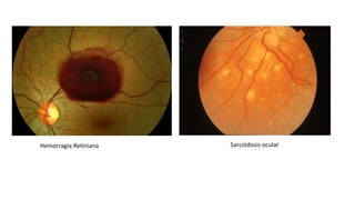 Hemorragia Retiniana Sarcoidosis ocular
 