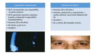 Espondilitis Anquilosante
• 30 % de pacientes con espondilitis
→uveítis anterior
• 30 % pacientes varones y jóvenes
(uveítis unilateral)→ espondilitis
anquilopoyética.
• Varones (20 y 40 años)
• Dx clínico y por la rx
• HLAB27+
Síndrome de Reiter:
• Varones (20 a 40 años )
• Uretritis, poliartritis y conjuntivitis +
uveítis anterior recurrente bilateral (20
%)
• HLA B27 +
• Rx y cultivo del exudado uretral.
 