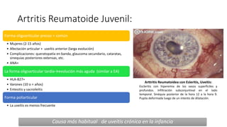 Artritis Reumatoide Juvenil:
Forma oligoarticular precoz + común
• Mujeres (2-15 años)
• Afectación articular + uveítis anterior (larga evolución)
• Complicaciones: queratopatía en banda, glaucoma secundario, cataratas,
sinequias posteriores extensas, etc.
• ANA+
La forma oligoarticular tardía→evolución más aguda (similar a EA)
• HLA-B27+
• Varones (10 o + años)
• Entesitis y sacroileítis
Forma poliarticular
• La uveítis es menos frecuente
Causa más habitual de uveítis crónica en la infancia
Arttritis Reumatoidea con Esleritis, Uveitis:
Escleritis con hiperemia de los vasos superficiles y
profundos. Infiltración subconjuntival en el lado
temporal. Sinéquia posterior de la hora 12 a la hora 9.
Pupila deformada luego de un intento de dilatación.
 