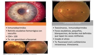 Citomegalovirus:
• Inmunodeprimidos
• Retinitis exudativo-hemorrágica con
vasculitis
• CD4 < 100
• Tx: con ganciclovir o foscarnet
Candidiasis ocular:
• Toxicómanos, Inmunodeprimidos
• Focos exudativos, pequeños,
blanquecinos, de bordes mal definidos
que tapan los vasos retiñíanos
• Invade el vitreo
• Tx: fluconazol oral o anfotericina
intravenosa. Vitrectomía.
 