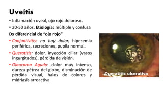 Uveítis
• Inflamación uveal, ojo rojo doloroso.
• 20-50 años. Etiología: múltiple y confusa
Dx diferencial de “ojo rojo”
• Conjuntivitis: no hay dolor, hiperemia
periférica, secreciones, pupila normal.
• Queratitis: dolor, inyección ciliar (vasos
ingurgitados), pérdida de visión.
• Glaucoma Agudo: dolor muy intenso,
dureza pétrea del globo, disminución de
pérdida visual, halos de colores y
midriasis arreactiva.
 