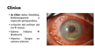 Clínica
• Sx Ciliar: dolor, fotofobia,
blefaroespasmo e
inyección periquerática.
• Irritación del esfínter del
iris miosis.
• Edema Iridiano 
Bradicoria
• Hipema: Sangre en
camara anterior.
 