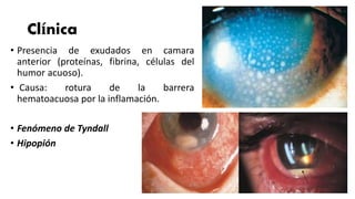 • Presencia de exudados en camara
anterior (proteínas, fibrina, células del
humor acuoso).
• Causa: rotura de la barrera
hematoacuosa por la inflamación.
• Fenómeno de Tyndall
• Hipopión
Clínica
 