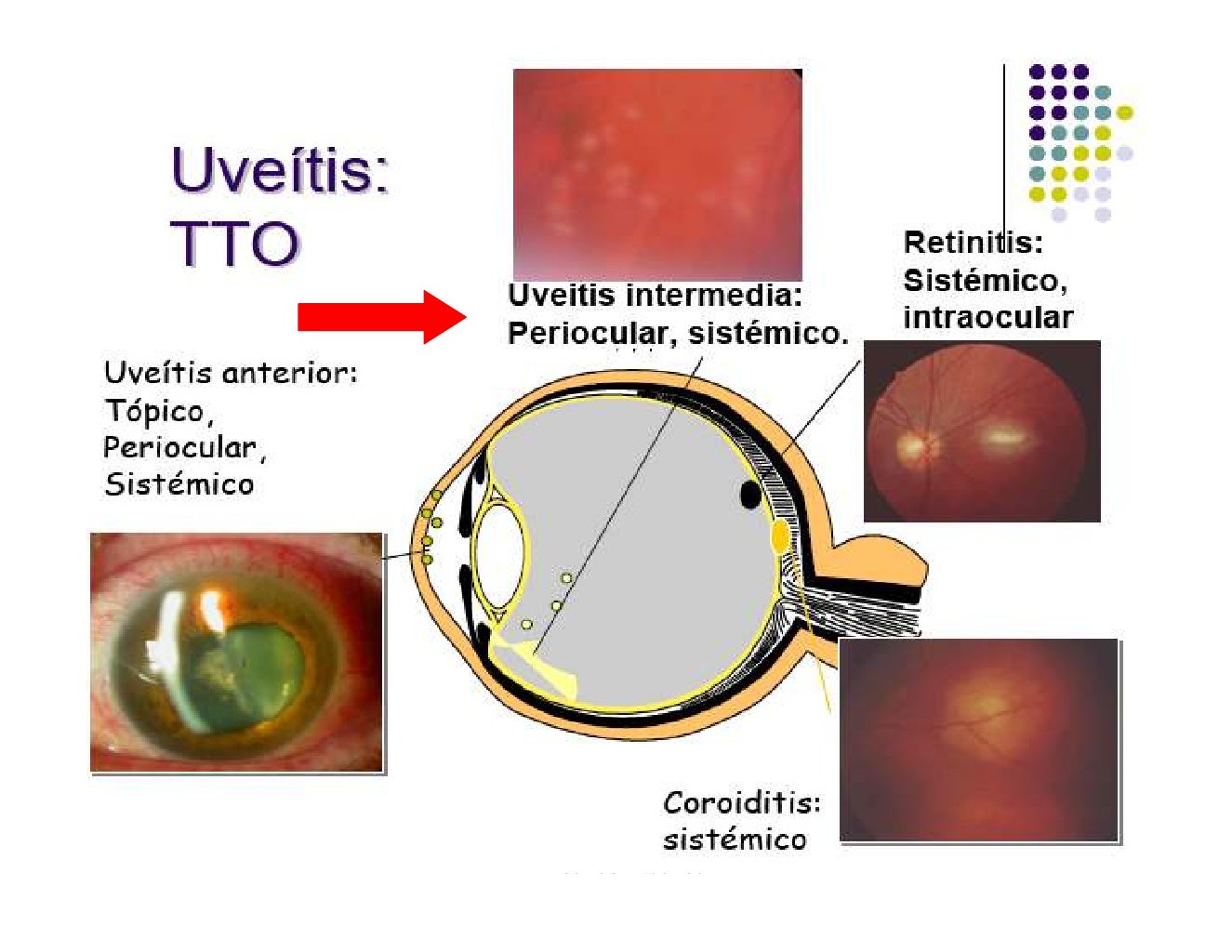 Uveitis Intermedia