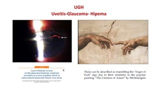 UGH
Uveítis-Glaucoma- Hipema
 