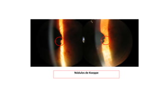 Nódulos de Koeppe
 
