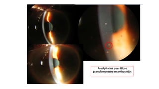 Precipitados queráticos
granulomatosos en ambos ojos
 