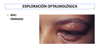 o BMC:
PÁRPADOS
EXPLORACIÓN OFTALMOLÓGICA
 