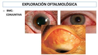 o BMC:
CONJUNTIVA
EXPLORACIÓN OFTALMOLÓGICA
 