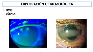 o BMC:
CÓRNEA
EXPLORACIÓN OFTALMOLÓGICA
 
