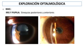 o BMC:
IRIS Y PUPILA: Sinequias posteriores y anteriores
EXPLORACIÓN OFTALMOLÓGICA
 
