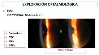 o BMC:
IRIS Y PUPILA: Nódulos de iris
EXPLORACIÓN OFTALMOLÓGICA
Nódulos de Koeppe
 Sarcoidosis
 TBC
 VKH
 Sífilis
 
