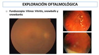 o Funduscopia: Vítreo: Vitritis, snowballs y
snowbanks
EXPLORACIÓN OFTALMOLÓGICA
 