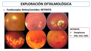 EXPLORACIÓN OFTALMOLÓGICA
o Funduscopia: Retina/coroides: RETINITIS
RETINITIS
 Toxoplasma
 VHS, VVZ, CMV
 