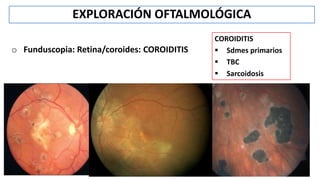EXPLORACIÓN OFTALMOLÓGICA
o Funduscopia: Retina/coroides: COROIDITIS
COROIDITIS
 Sdmes primarios
 TBC
 Sarcoidosis
 