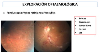 o Funduscopia: Vasos retinianos: Vasculitis
EXPLORACIÓN OFTALMOLÓGICA
 Behcet
 Sarcoidosis
 Toxoplasma
 Herpes
 LES
 
